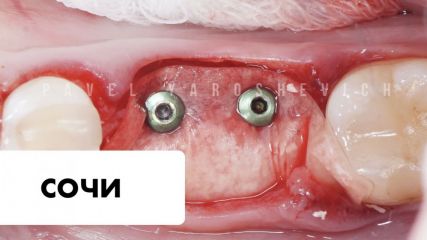 Протоколы костной и мягкотканной аугментации Протоколы костной и мягкотканной аугментации